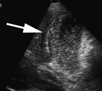 Percutaneous Cholecystostomy | Radiology Key