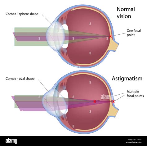 Visual common disease disorder anatomy condition oval optometry human ...