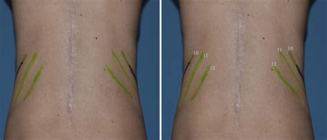 The Incision and Resultant Scar from Rib Removal Surgery for Waistline Reduction - Explore ...