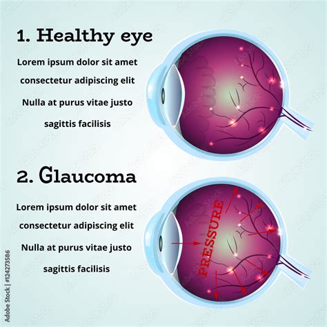 Eye Diseases Glaucoma