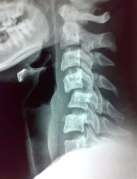 Cervical Injury Xrays | Bone and Spine