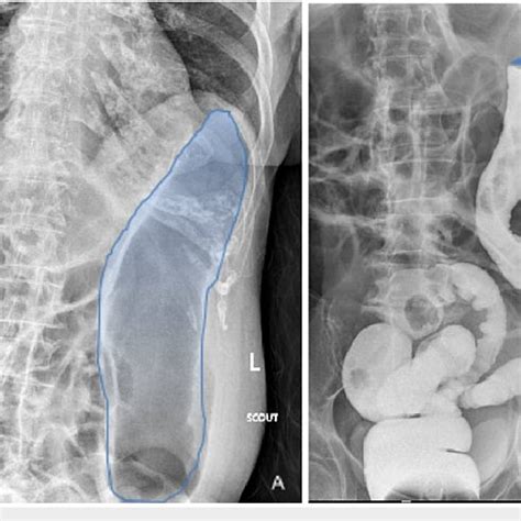 X-ray of the large intestine showing dilated loops of bowel with loss ...