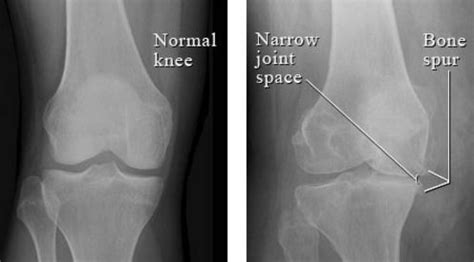 Osteoarthritis - What is?, Definition, ICD 9 Code, Symptoms, Treatment