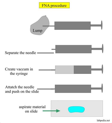 FNAC, Fine needle aspiration Cytology (FNAB, Fine needle aspiration biopsy) – Labpedia.net