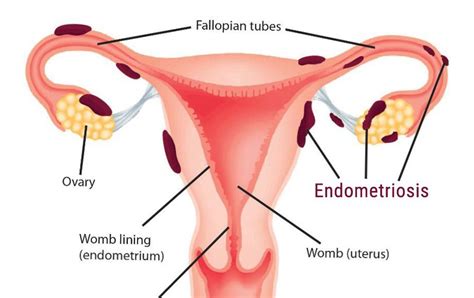 Endometriosis – Gynoveda