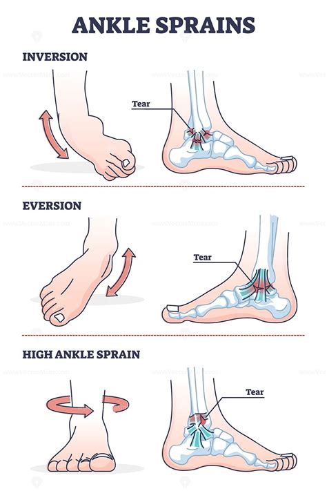 Ankle sprains situations with inversion and eversion injury outline diagram. Twisted foot or leg ...