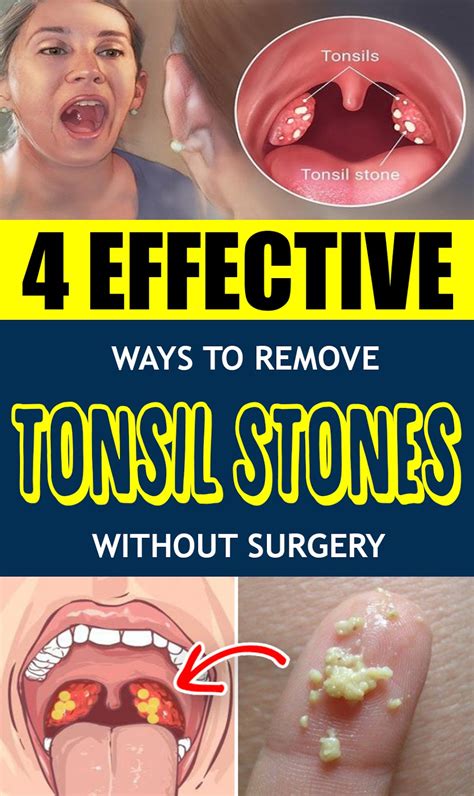 4 EFFECTIVE WAYS TO REMOVE TONSIL STONES WITHOUT SURGERY - BEAUTY HACKS