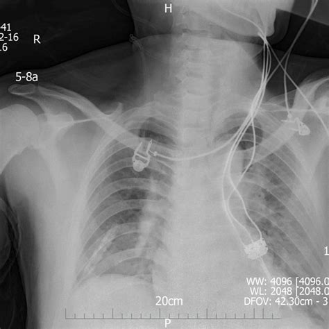 Chest radiography at 1 d after left heart failure. | Download ...