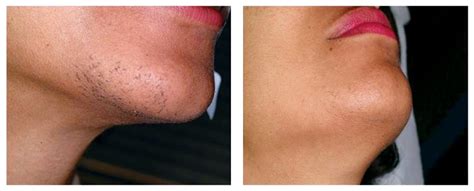 Before and After | Renova Laser Hair Removal & MedSpa Houston TX