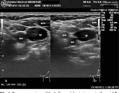 Carotid Arteries Ultrasound