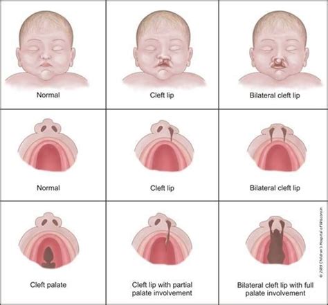 Cleft Awareness | How Do You Do It? | Cleft lip and palate, Cleft palate, Cleft lip