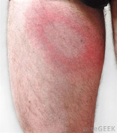 The characteristic bullseye rash for Lyme disease | Innatoss