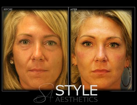 Liquid Facelift - Style Aesthetics