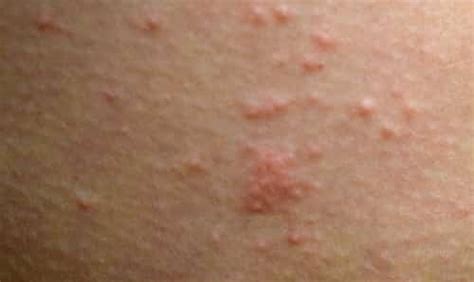 Over-the-counter Medicines to Treat Scabies - IYTmed.com