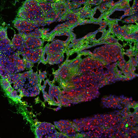 Tumors' mechanical properties affect protein production | Cornell Chronicle