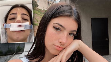 Charli D'Amelio Surgery: Goes Under Knife To Fix Nose