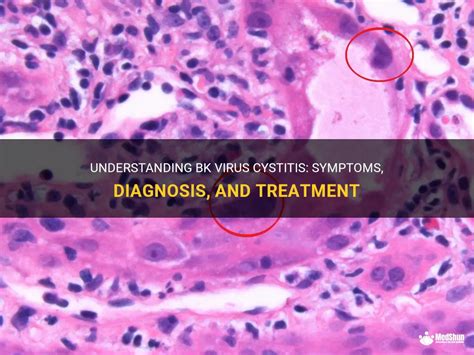 Understanding Bk Virus Cystitis: Symptoms, Diagnosis, And Treatment | MedShun