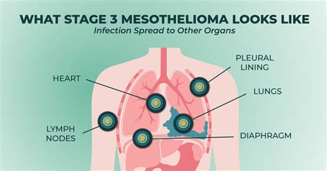 Understanding Mesothelioma Stages and Treatment: A Comprehensive Guide - Mesothelioma Insurance ...