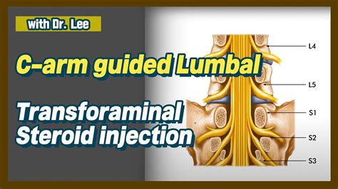 lumbar L5 transforaminal, L5-S1 facet joint injection: C arm, lecture ...