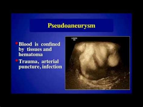 Pseudoaneurysms: Diagnosis and Treatment - YouTube