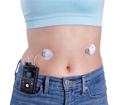 Diabete: Medtronic lancia il sistema automatizzato per l’infusione di ...