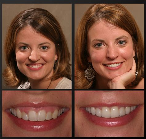 Laser Gum Treatment Rochester, MI | Swollen, Red Gums