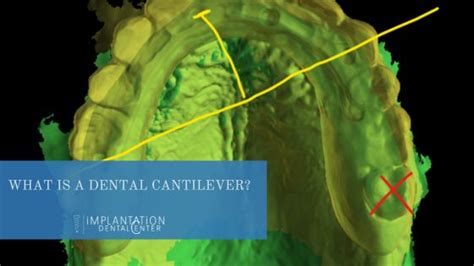 What is a cantilever bridge on a dental prosthesis? · Implantation Dental Center