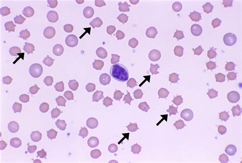 Acanthocytes – Cells and Smears