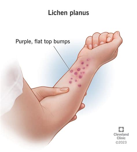 Understanding Lichen Planus: Causes, Symptoms, and Treatment - Ask The Nurse Expert