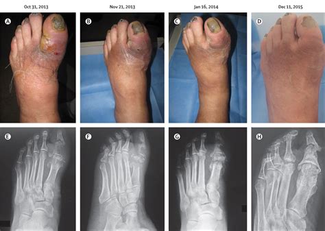 Non-surgical treatment of diabetic foot osteomyelitis - The Lancet Diabetes & Endocrinology