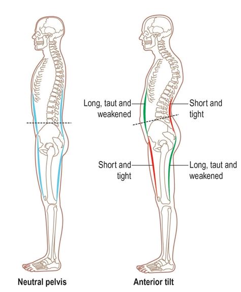 Anterior Pelvic Tilt Posture