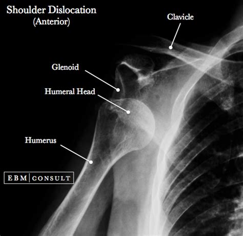 Anterior Shoulder Dislocation - General Review