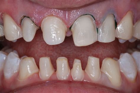 Case 16, Anterior Esthetic Makeover with Crowns, Veneers and Invisalign ...