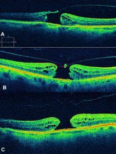 Do You Have A Macular Hole? | Dr Mulonga, Durban Ophthalmologist – We Care