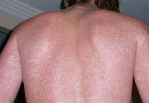 Lamictal Rash | New Health Guide