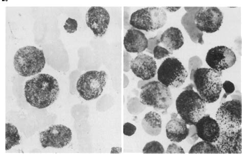 Figure 1 from Promyelocyte morphology. Differentiation of acute promyelocytic leukemia from ...