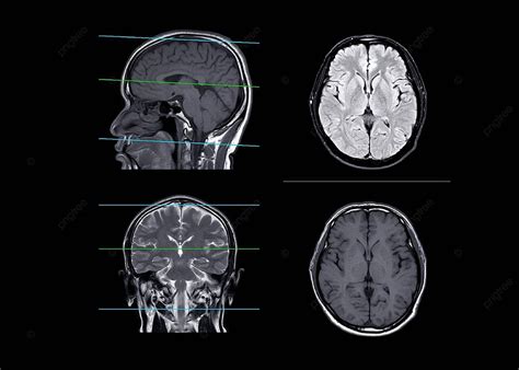 Comparison Of Brain Mri In Axial Coronal And Sagittal Planes Photo ...