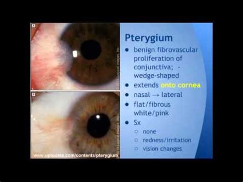 Pterygium vs Pinguecula: "EM in 5" - YouTube