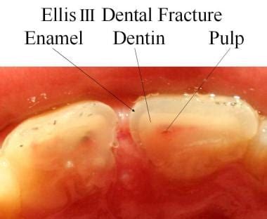 Tooth Fracture: Practice Essentials, Pathophysiology, Etiology