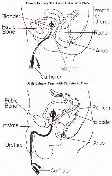 19 Best catheter images | Foley catheter, Nursing tips, Urinary catheterization