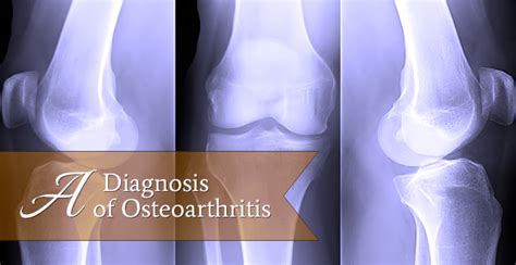 A Diagnosis of Osteoarthritis - Alive65