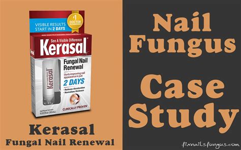 Kerasal Fungal Nail Renewal - Review & Case Study (2023)