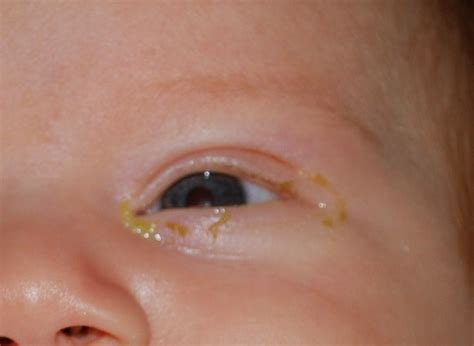 Blocked Tear Duct - Symptoms, Treatment, Surgery, Pictures, Causes