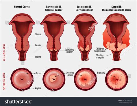 136 Stages of cervical cancer Images, Stock Photos & Vectors | Shutterstock