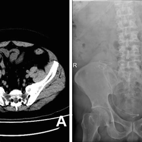 The placement of a double-J stent in a 32-year-old female with a right... | Download Scientific ...