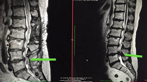 Lumbar Spine Mri Lumbar Spinal Stenosis Mri Health Lumbar Spinal | The Best Porn Website