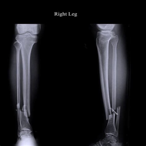 Major trial casts doubt on leading device to heal bone fractures