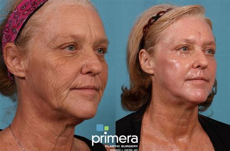 Chemical Peel Before and After Pictures Case 197 | Orlando & Tampa ...