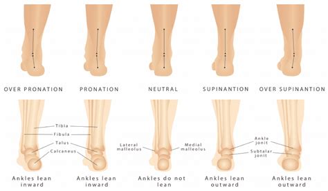 Orthotics | Foot Orthoses | ACC Chiropractic Clinic