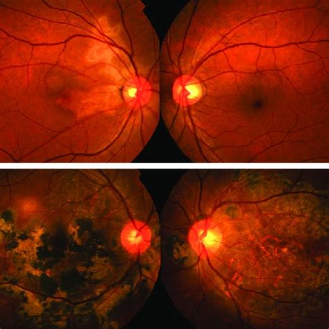 Comparison of serpiginous-like choroiditis in ocular tuberculosis (A)... | Download Scientific ...